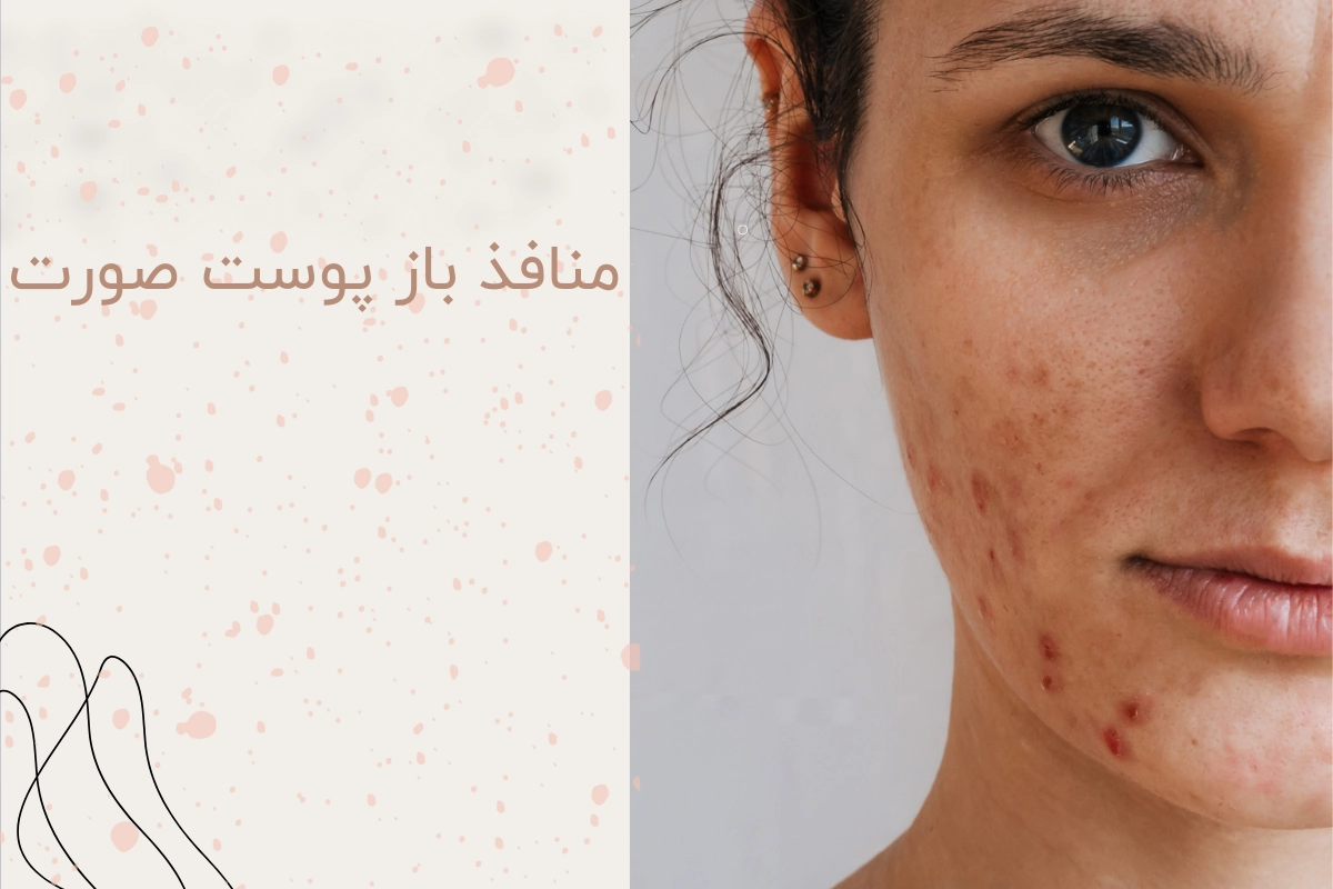 روش‌های درمان منافذ باز پوست صورت