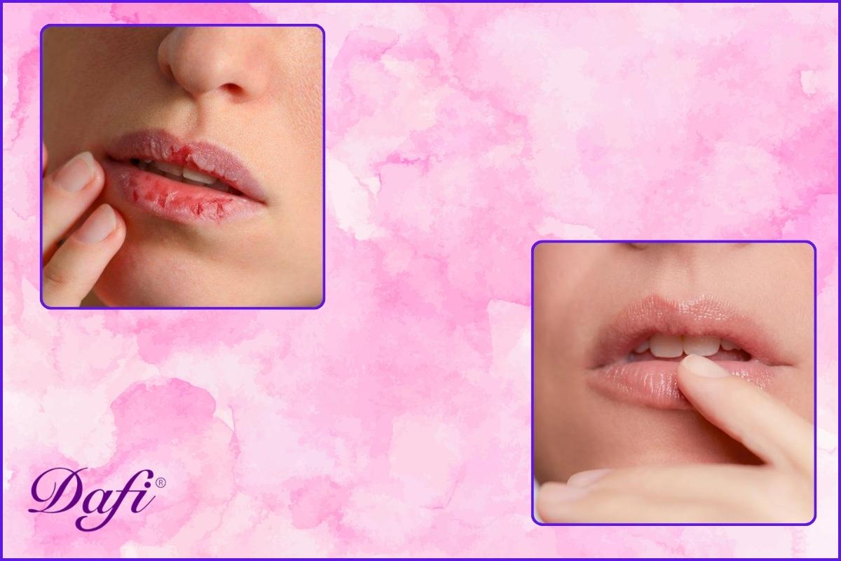 علت خشکی لب چیست؟ + روش درمان خشکی لب