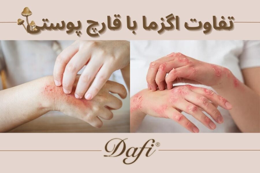 تفاوت اگزما و قارچ پوستی چیست؟ + راه های تشخیص
