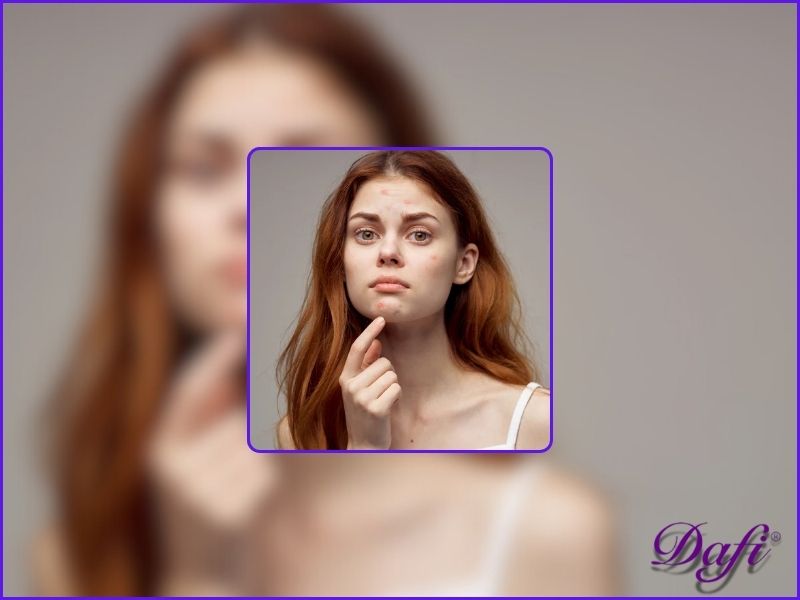 نکاتی برای مراقبت بهتر از پوست در دوران بلوغ