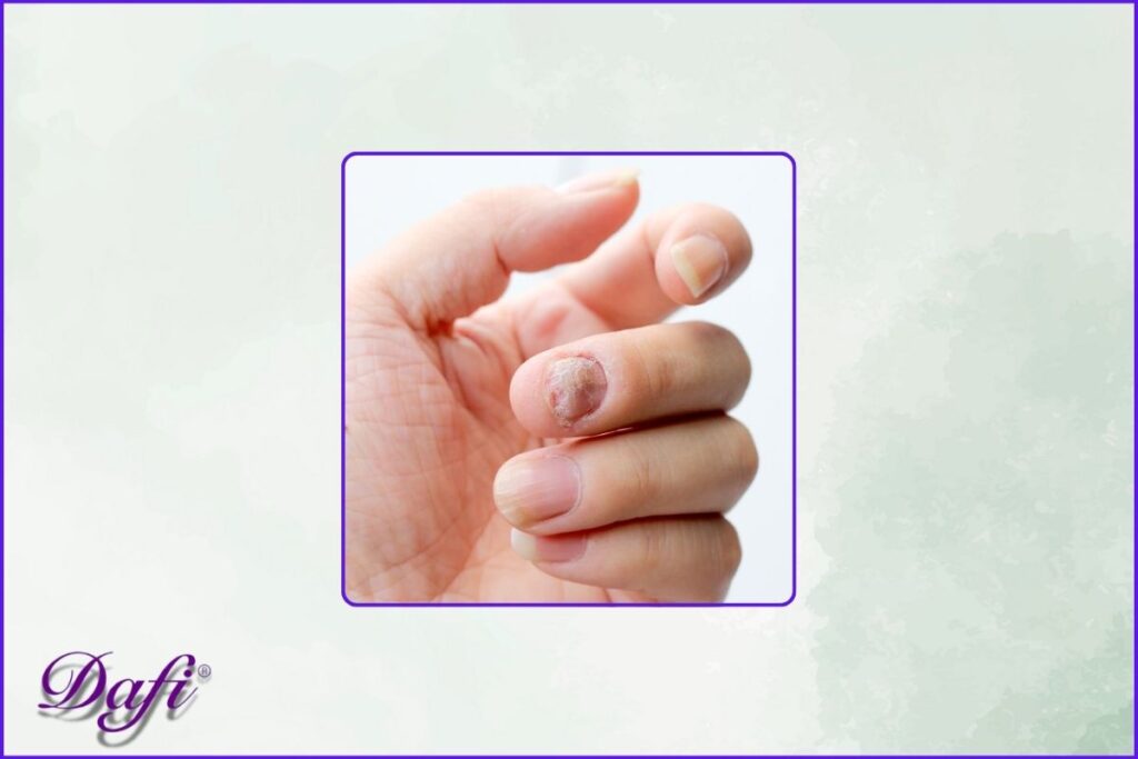 قارچ ناخون چیست؟ + راه حل