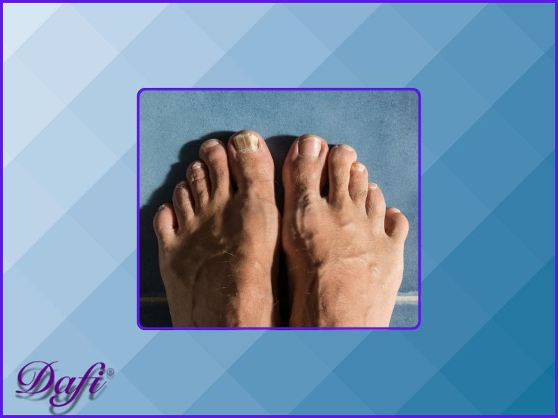 قارچ ناخن چیست؟