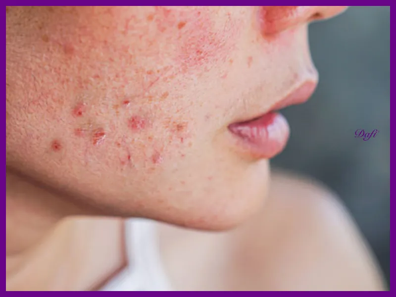 روتین پوستی مرحله به مرحله برای کاهش جوش چانه