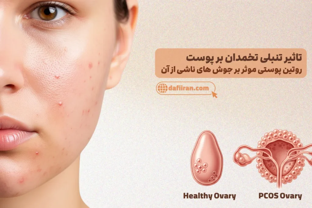 تاثیر تنبلی تخمدان بر روی پوست