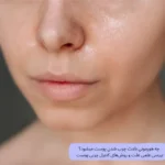 چه هورمونی باعث چرب شدن پوست می‌شود؟ + روش‌های علمی کنترل چربی پوست | مجله دافی