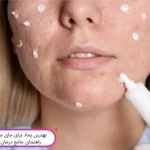 بهترین پماد برای جای جوش صورت؛ راهنمای جامع درمان جای جوش | مجله دافی