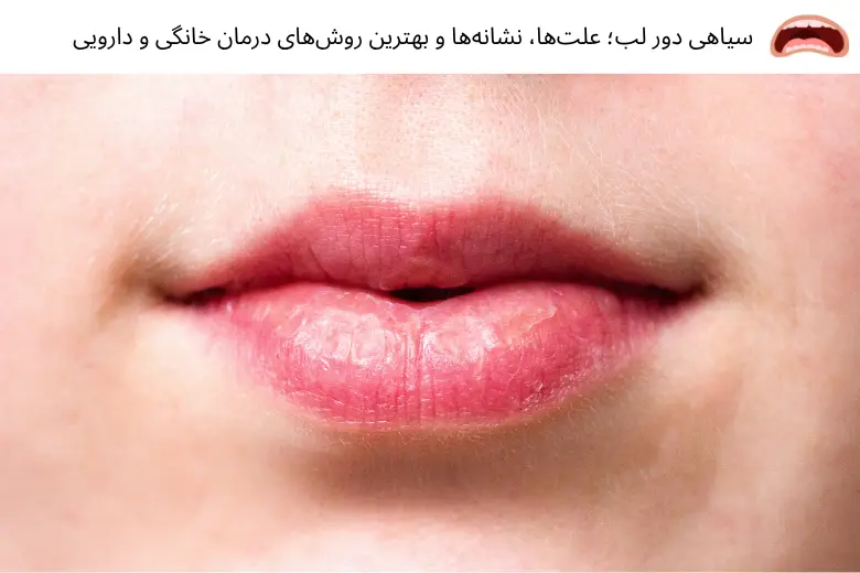 سیاهی دور لب؛ علت‌ها، نشانه‌ها و بهترین روش‌های درمان خانگی و دارویی | مجله دافی