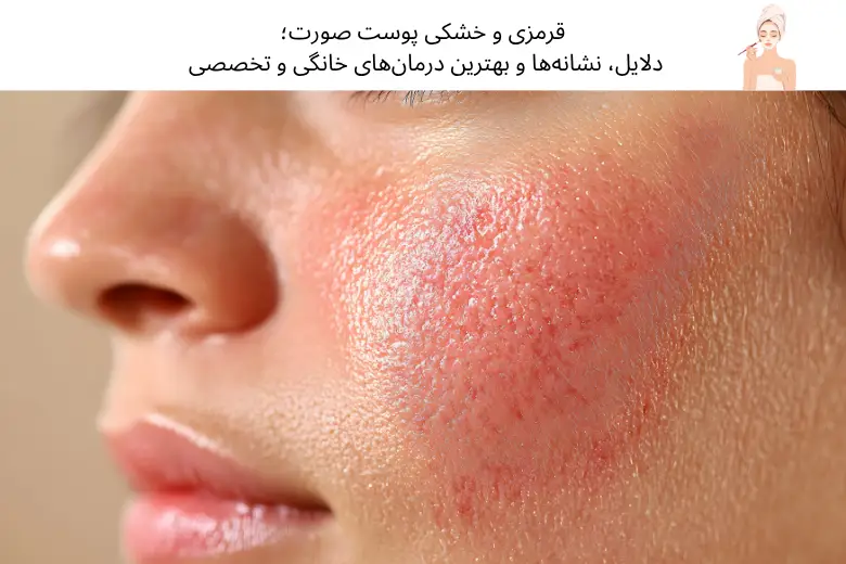 قرمزی و خشکی پوست صورت؛ دلایل، نشانه‌ها و بهترین درمان‌های خانگی و تخصصی | مجله دافی