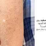 آیا لکه های سفید روی پوست نشانه کمبود ویتامین است؟ علت و روش‌های درمان سریع | مجله دافی