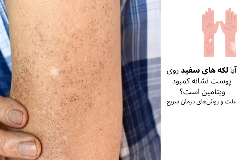 آیا لکه های سفید روی پوست نشانه کمبود ویتامین است؟ علت و روش‌های درمان سریع | مجله دافی