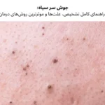 جوش سر سياه؛ راهنمای کامل تشخیص، علتها و موثرترین روشهای درمان | مجله دافی