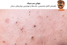 جوش سر سياه؛ راهنمای کامل تشخیص، علت‌ها و موثرترین روش‌های درمان | مجله دافی