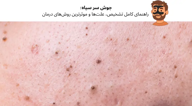 جوش سر سياه؛ راهنمای کامل تشخیص، علت‌ها و موثرترین روش‌های درمان | مجله دافی
