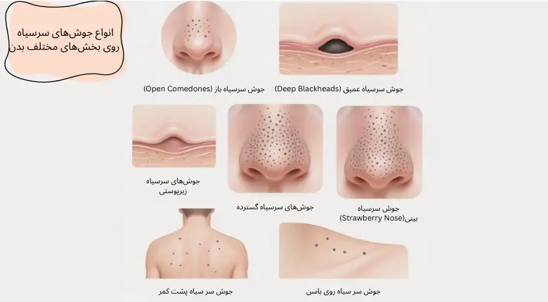 انواع جوشهای سرسیاه روی بخشهای مختلف بدن | مجله دافی