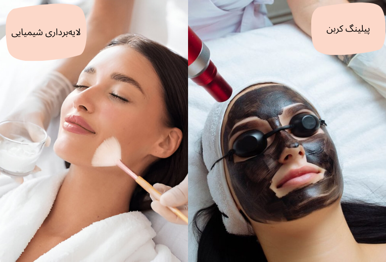 انواع پیلینگ صورت (پیلینگ کربن + لایه برداری شیمیایی) | مجله دافی